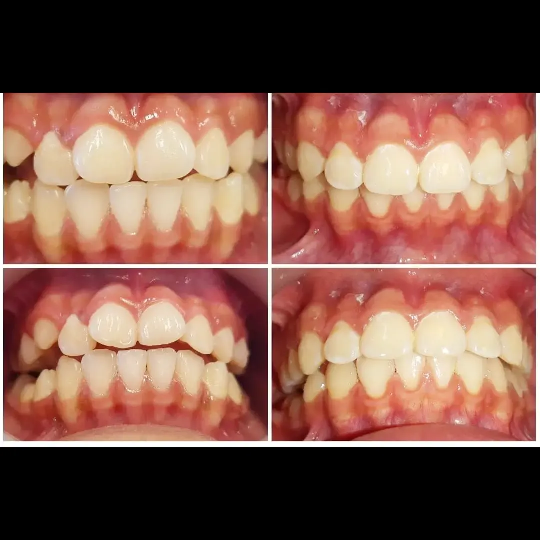 Dentibrack