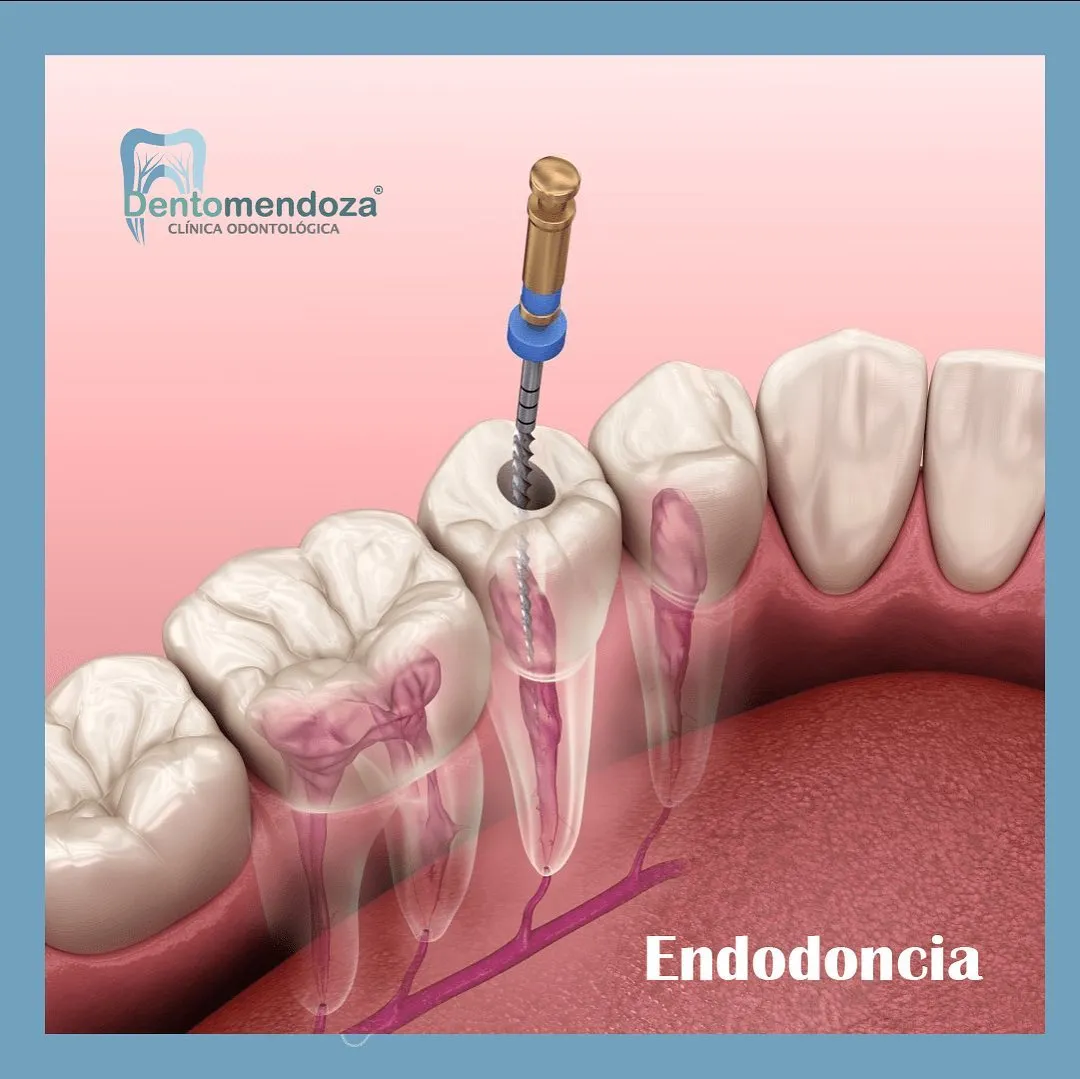 Dentomendoza